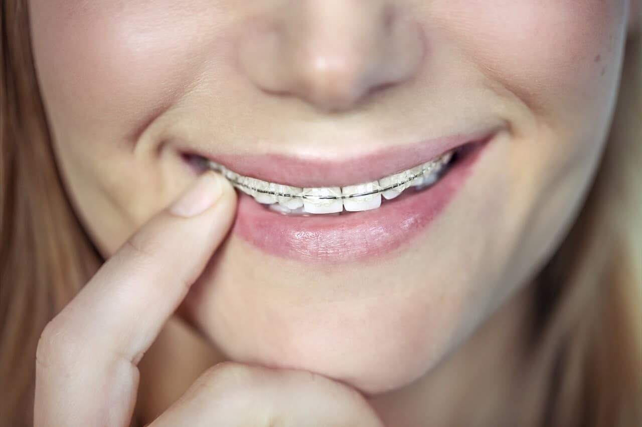Tipos y beneficios de los brackets estéticos
